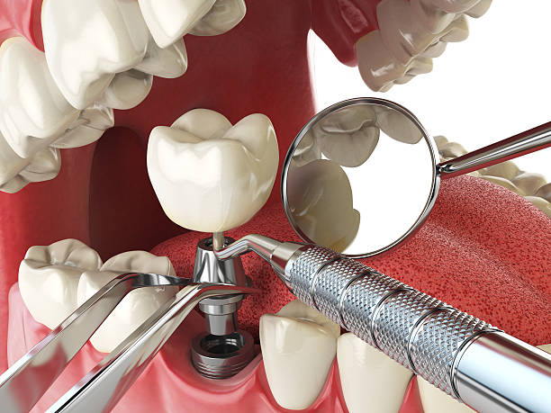 Best Emergency Dental Extractions in New Franklin, OH
